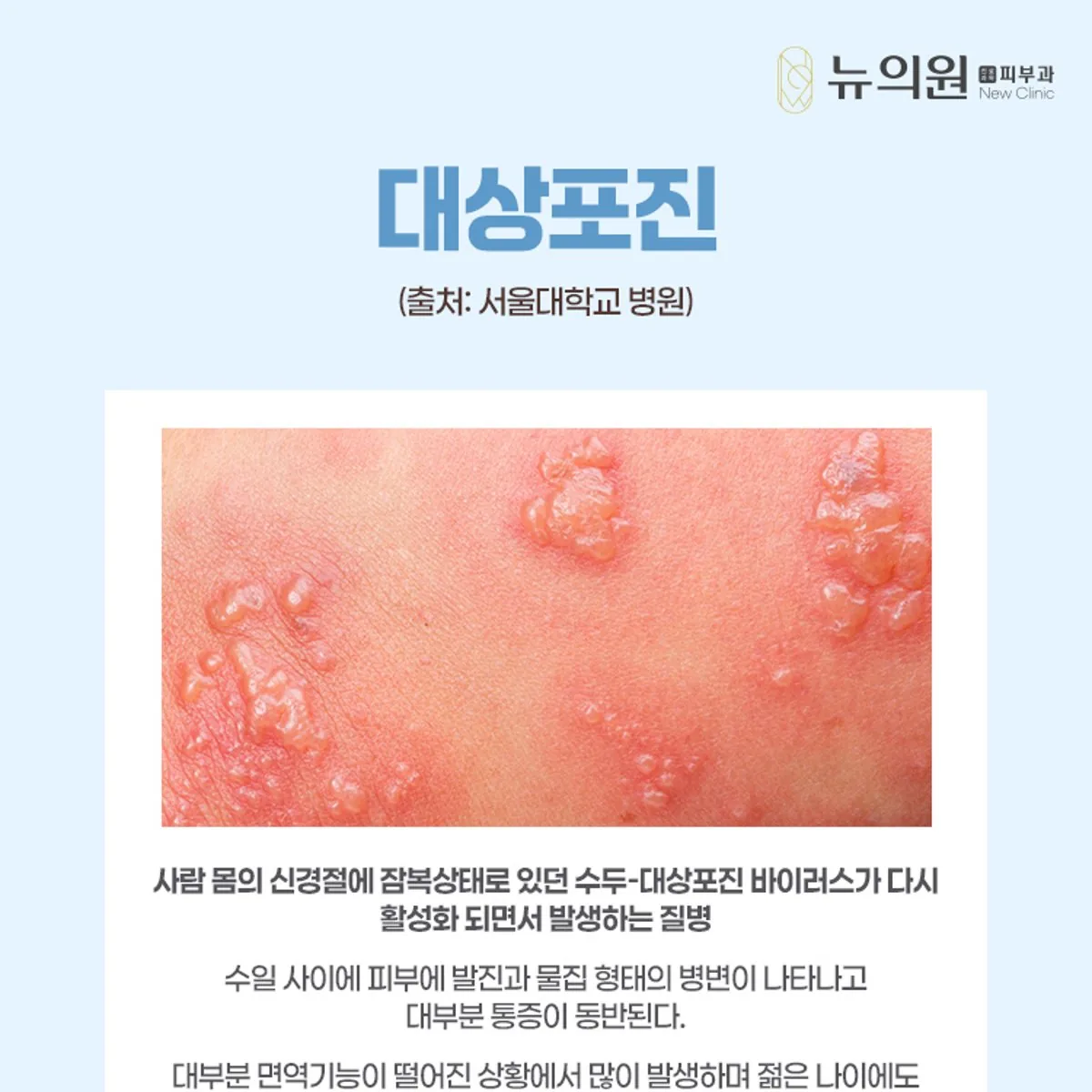 대상포진의 원인과 증상, 치료 방법을 정리한 뉴의원 안내 카드 이미지